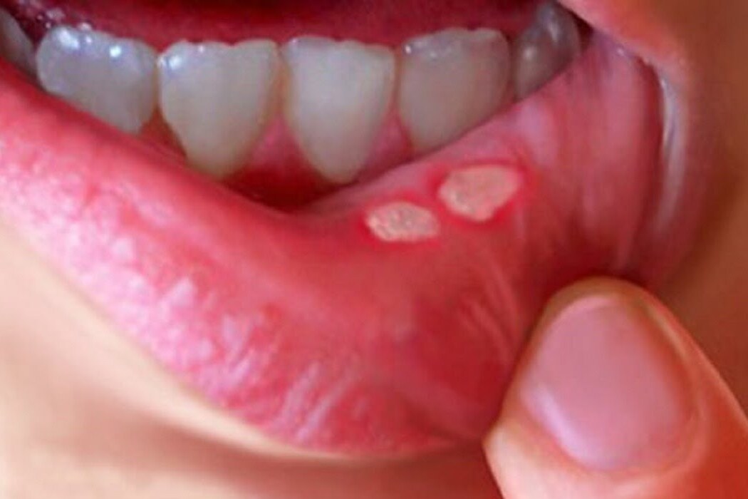 Mouth Sores