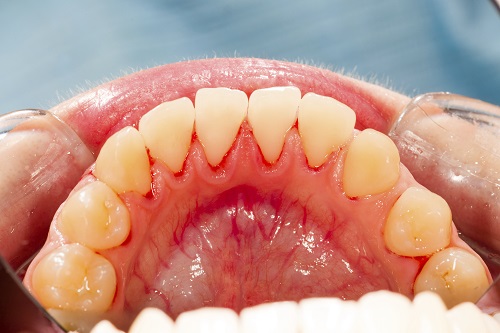 Periodontal Disease