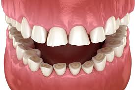 Bruxism