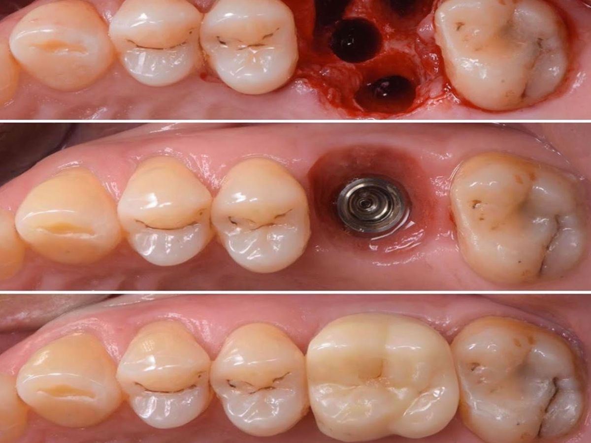 Same Day Implants